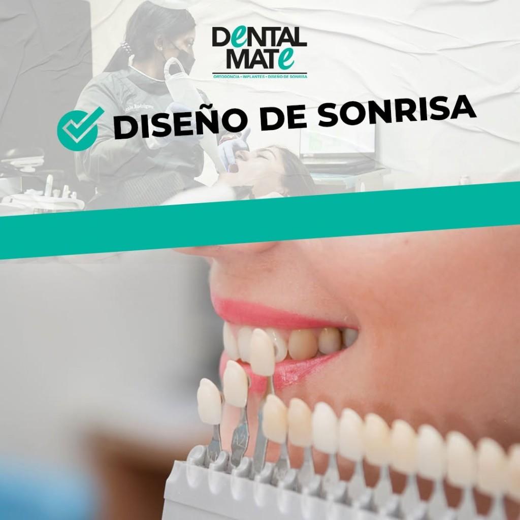 Diseño de sonrisa