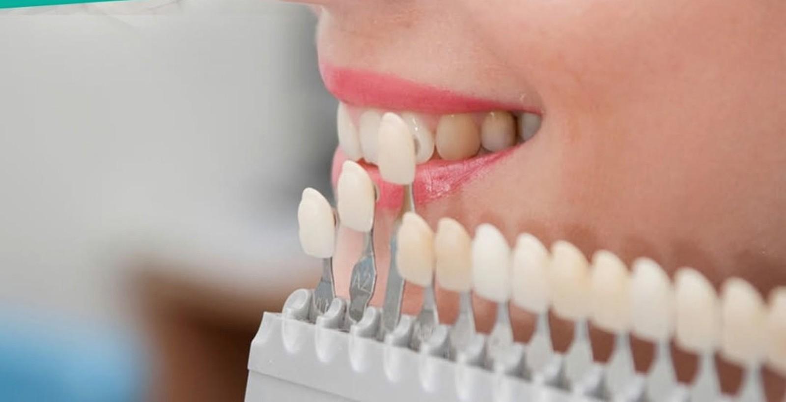 Diseño de sonrisa